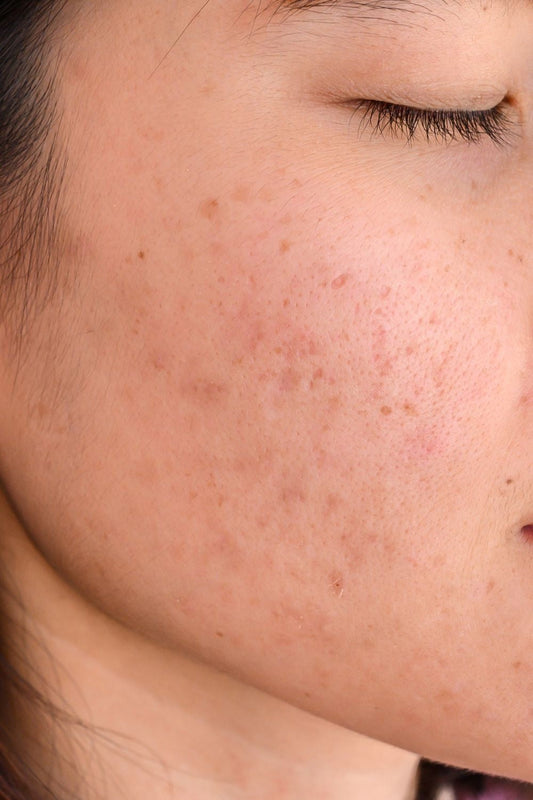 Comment apaiser une peau sensible naturellement ?